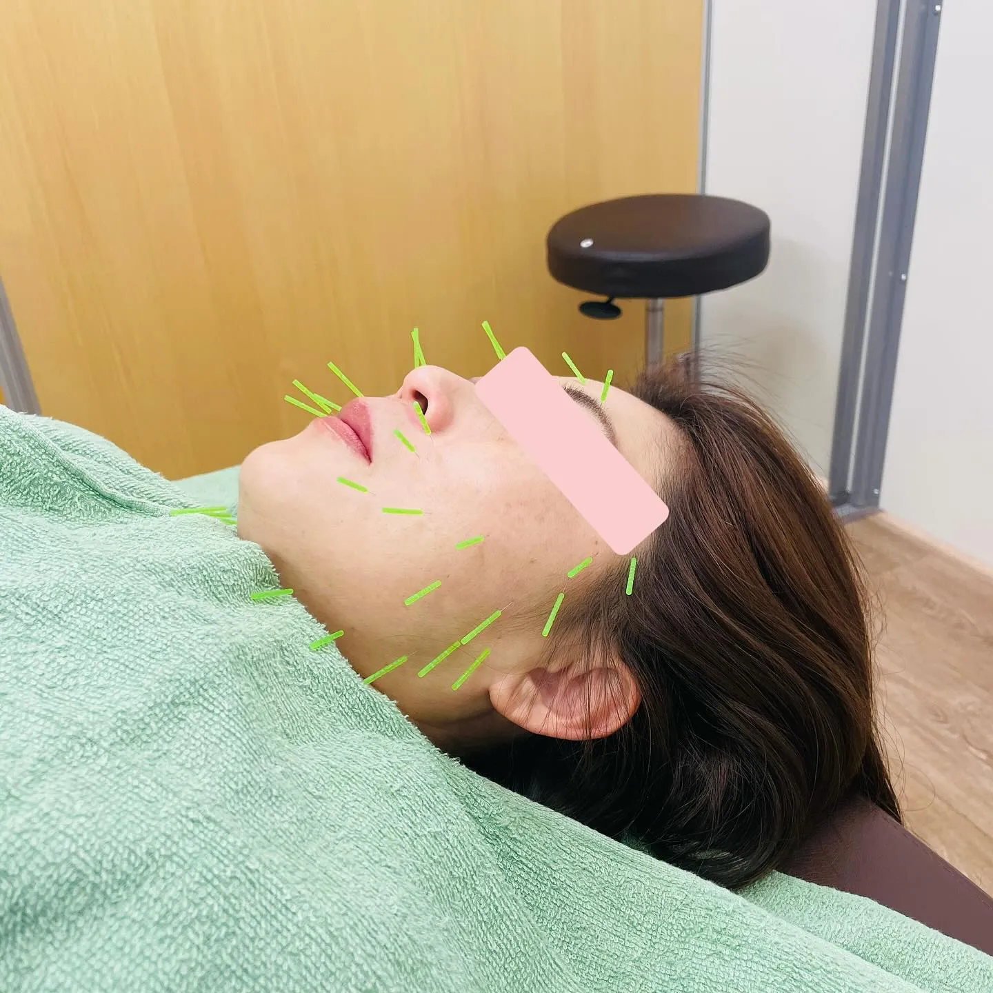 美容針の施術をさせていただきました💆🏻‍♀️